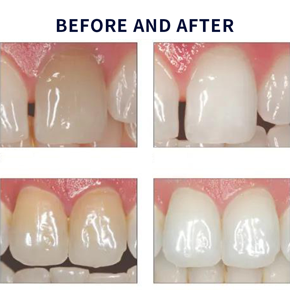 Opalescence Whitening 20% PF 2 – Teeth Whitening At Home Kit recenzja i cena