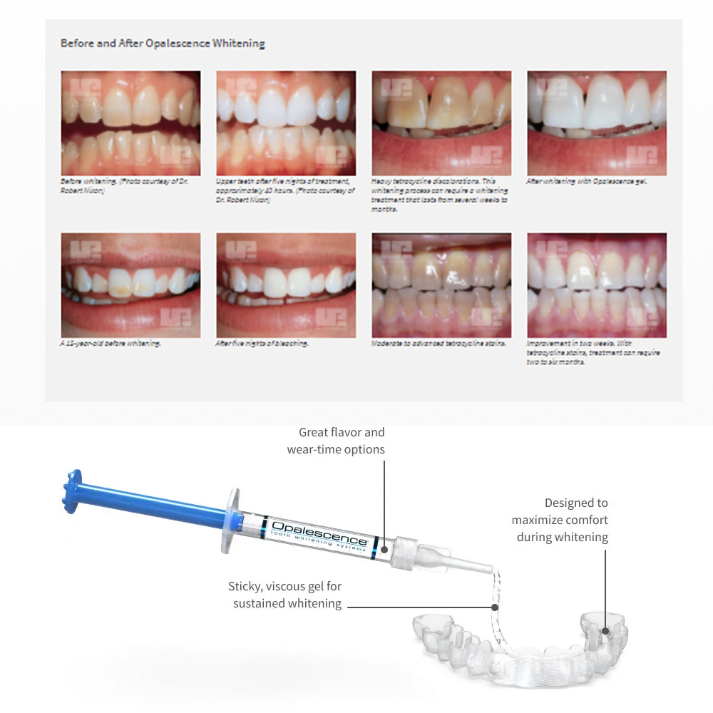 Opalescence Whitening 20% PF 2 – Teeth Whitening At Home Kit recenzja i cena