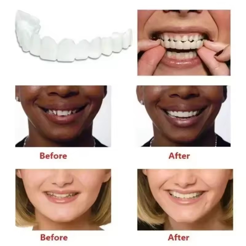 Teeth Veneers Whitening Dentur – Teeth Whitening Veneers recenzja i cena