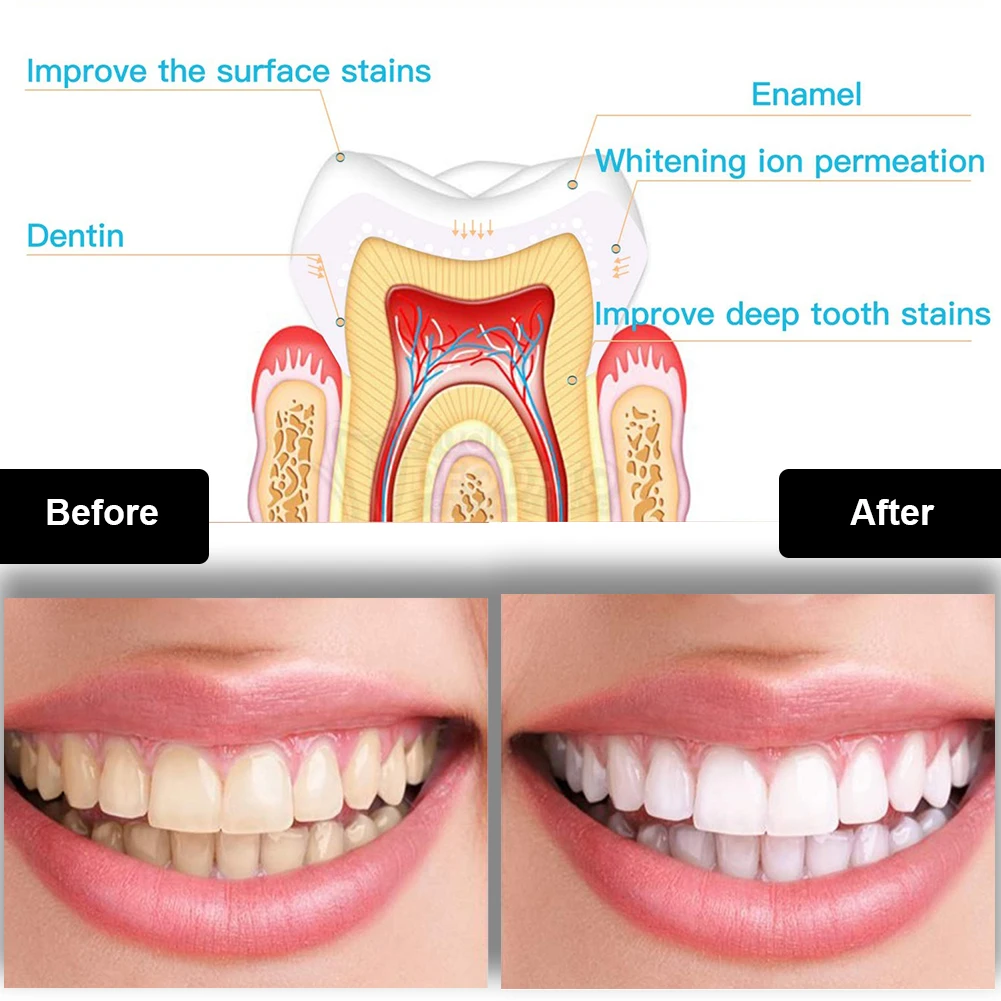 Dental Teeth Whitening Kit Min – Teeth Whitening Zoom recenzja i cena