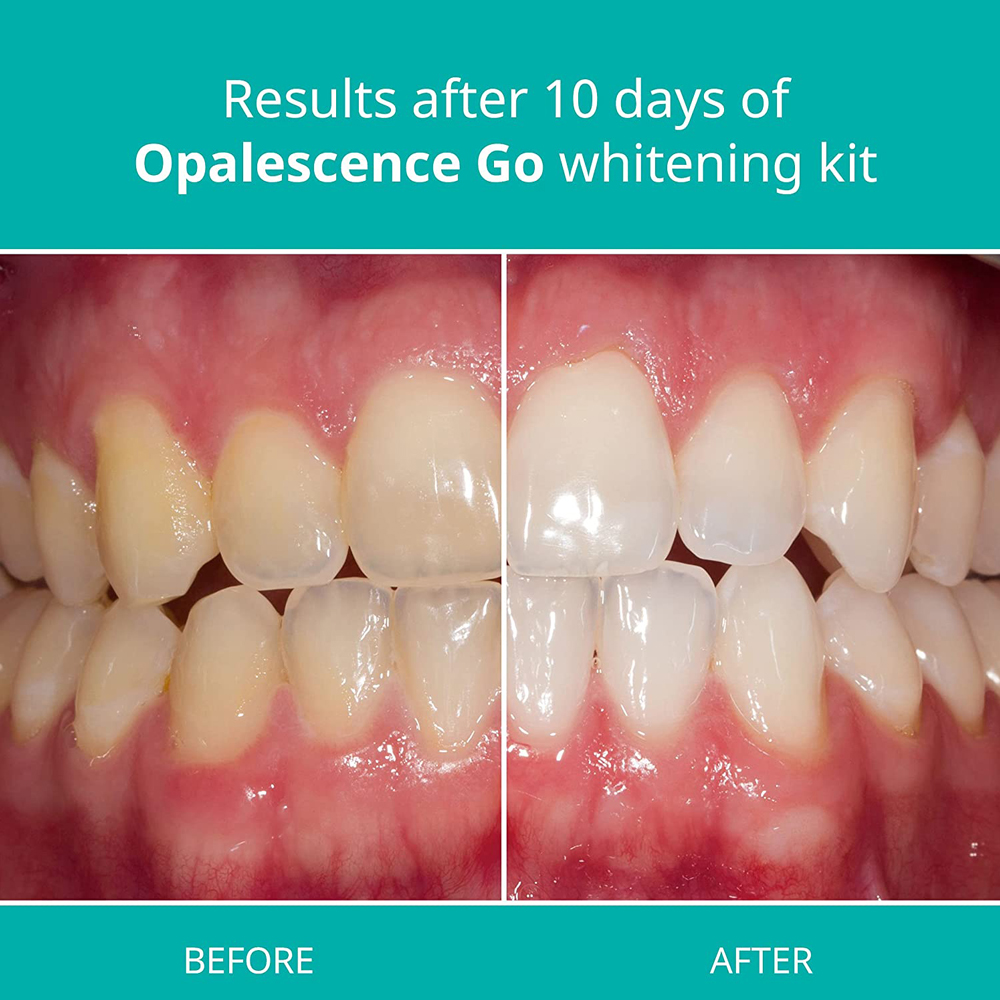 Opalescence Go Teeth Whitening – Teeth Whitening Opalescence Go recenzja i cena